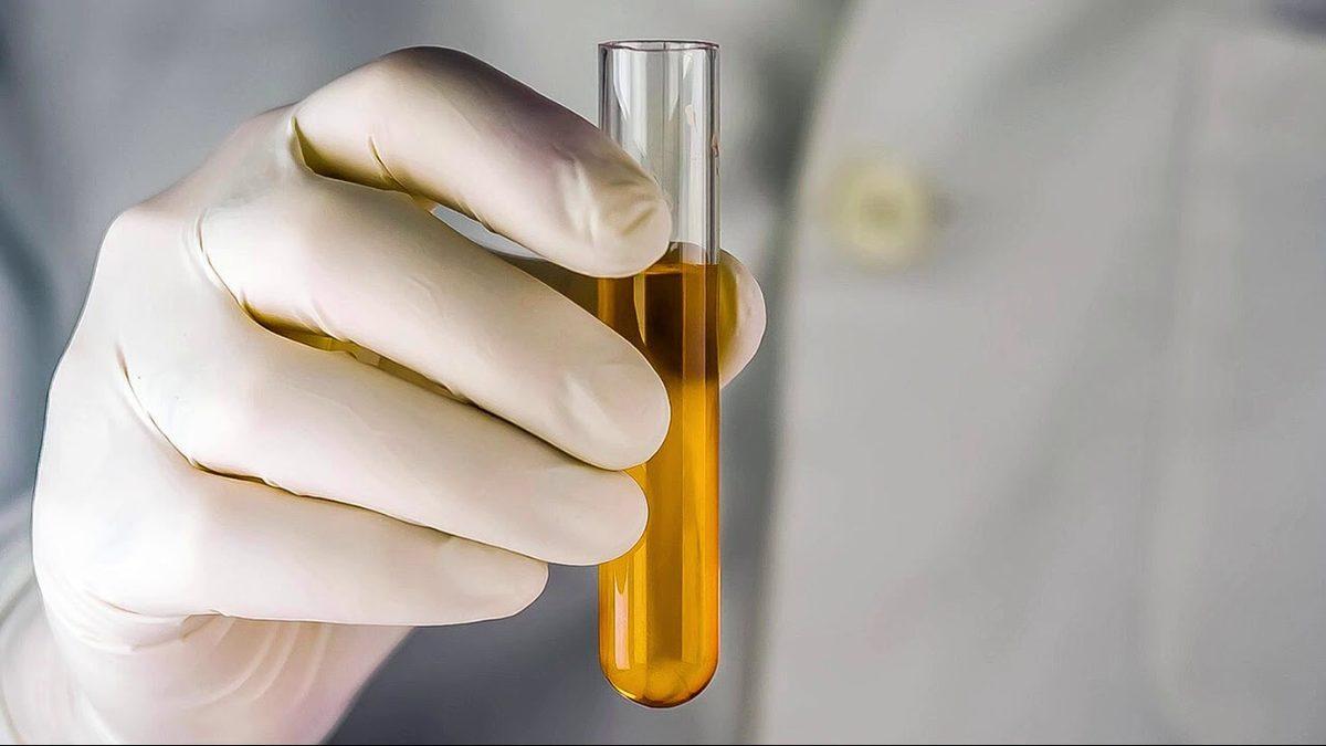 İdrar Tahlilinde Karşılaştığımız ve Sağlık Durumumuz Hakkında Bilgi Veren ’Dansite’ Nedir? Düşüklüğü ve Yüksekliği Ne Anlama Gelir?