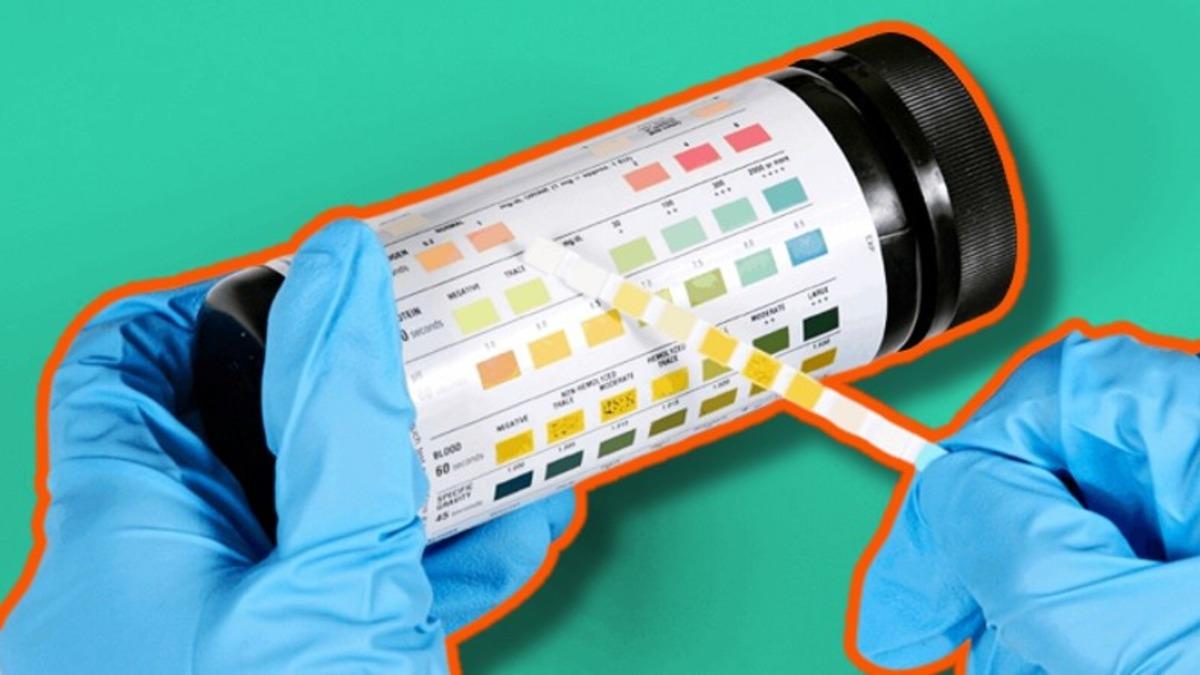 İdrar Tahlilinde Karşılaştığımız ve Sağlık Durumumuz Hakkında Bilgi Veren ’Dansite’ Nedir? Düşüklüğü ve Yüksekliği Ne Anlama Gelir?