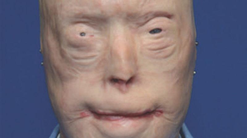 Yüzü Tamamen Yanan İtfaiyeci Başarılı Yüz Nakli Ameliyatı