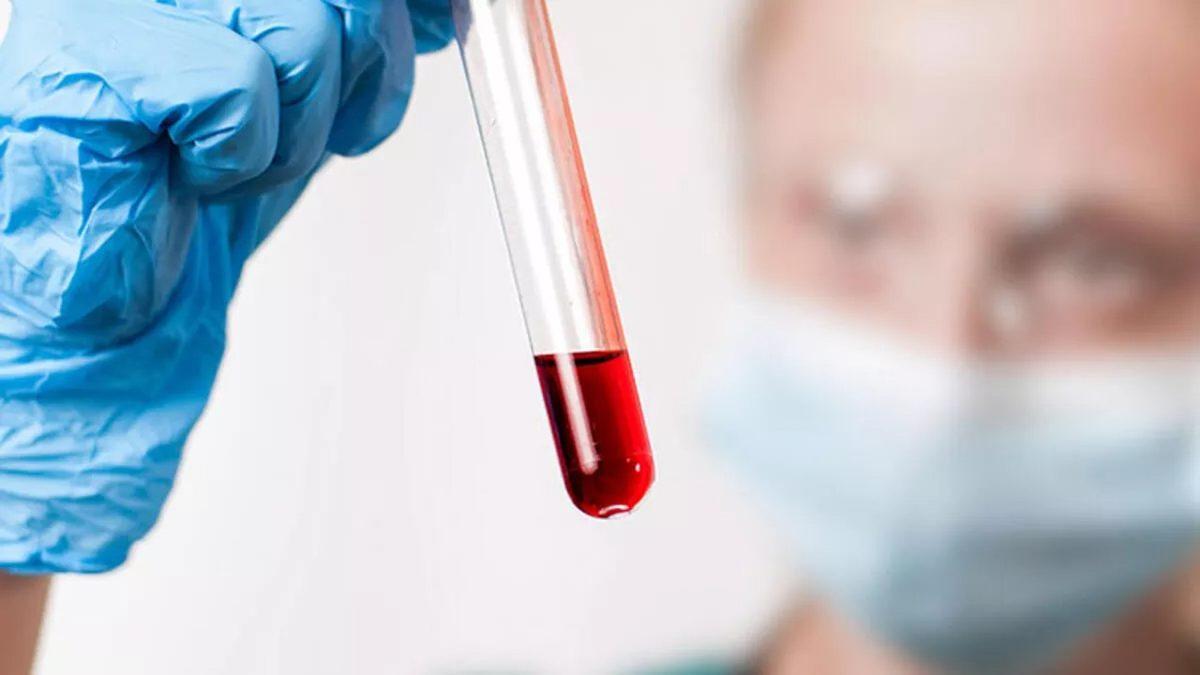 Karaciğer Sağlığımız Hakkında Önemli Bilgiler Veren ’Bilirubin’ Nedir, Yüksekliği ve Düşüklüğü Ne Anlama Gelir?