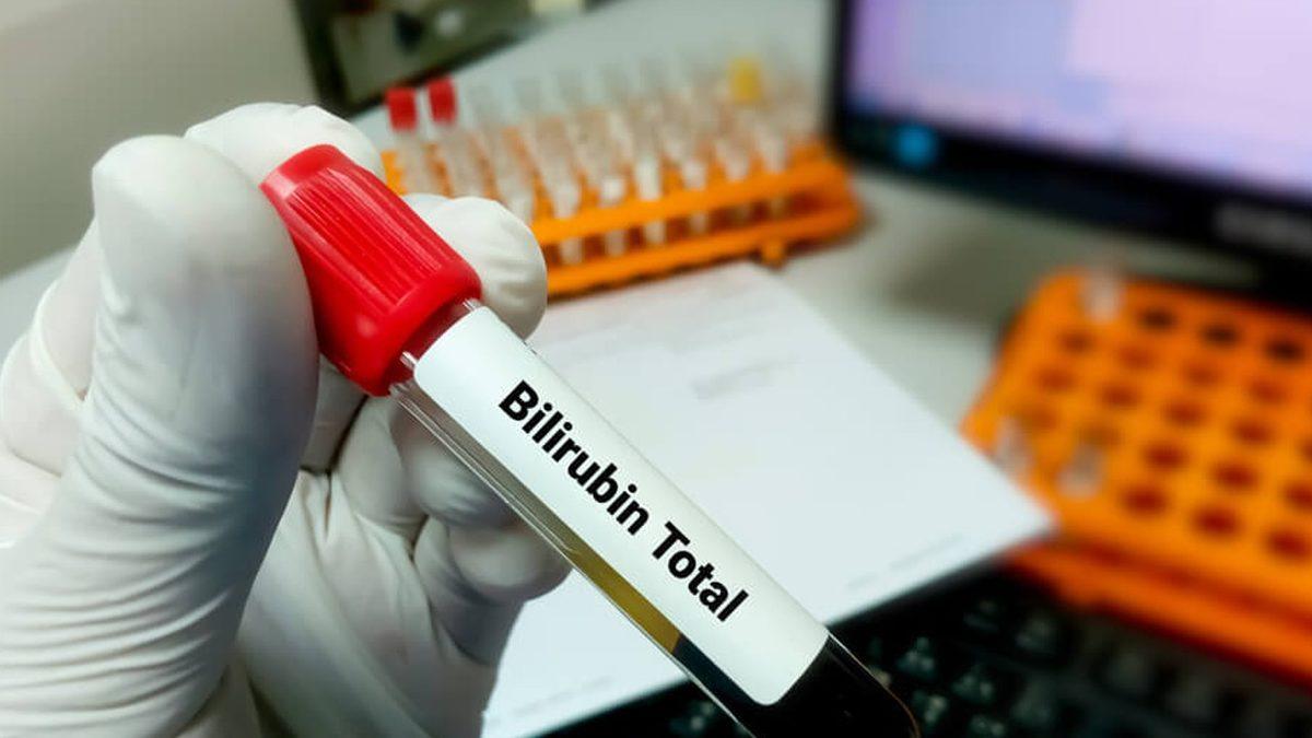 Karaciğer Sağlığımız Hakkında Önemli Bilgiler Veren ’Bilirubin’ Nedir, Yüksekliği ve Düşüklüğü Ne Anlama Gelir?