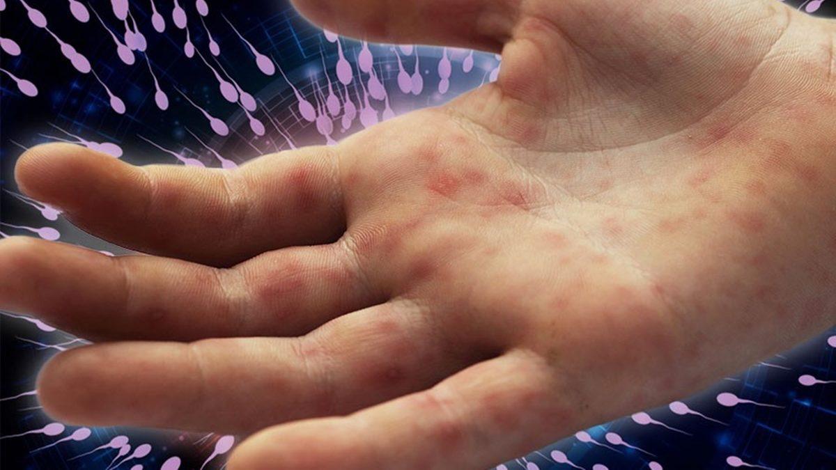 Genellikle Kadınlarda Görülse de Erkeklerin Vücudunda da İzlere Neden Olan ’Sperm Alerjisi’ Nedir?