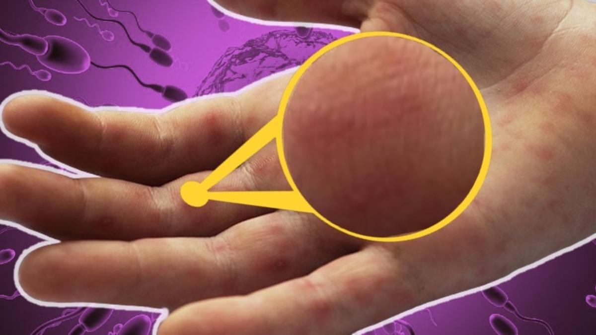 Genellikle Kadınlarda Görülse de Erkeklerin Vücudunda da İzlere Neden Olan ’Sperm Alerjisi’ Nedir?