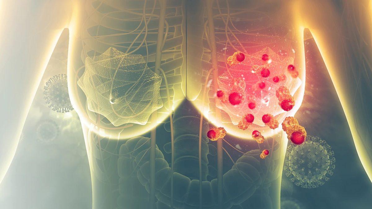 Kan Tahlilinde Karşımıza Çıkan ’CA 15-3’ Nedir, Neden Ciddiye Almalıyız?