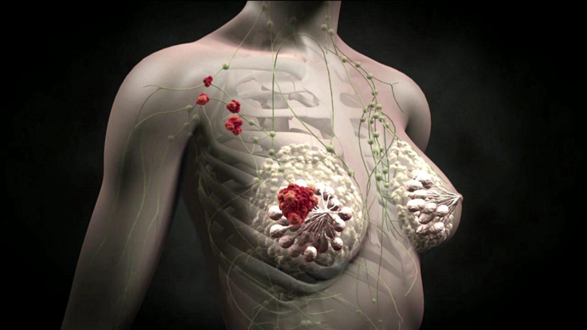 Kan Tahlilinde Karşımıza Çıkan ’CA 15-3’ Nedir, Neden Ciddiye Almalıyız?