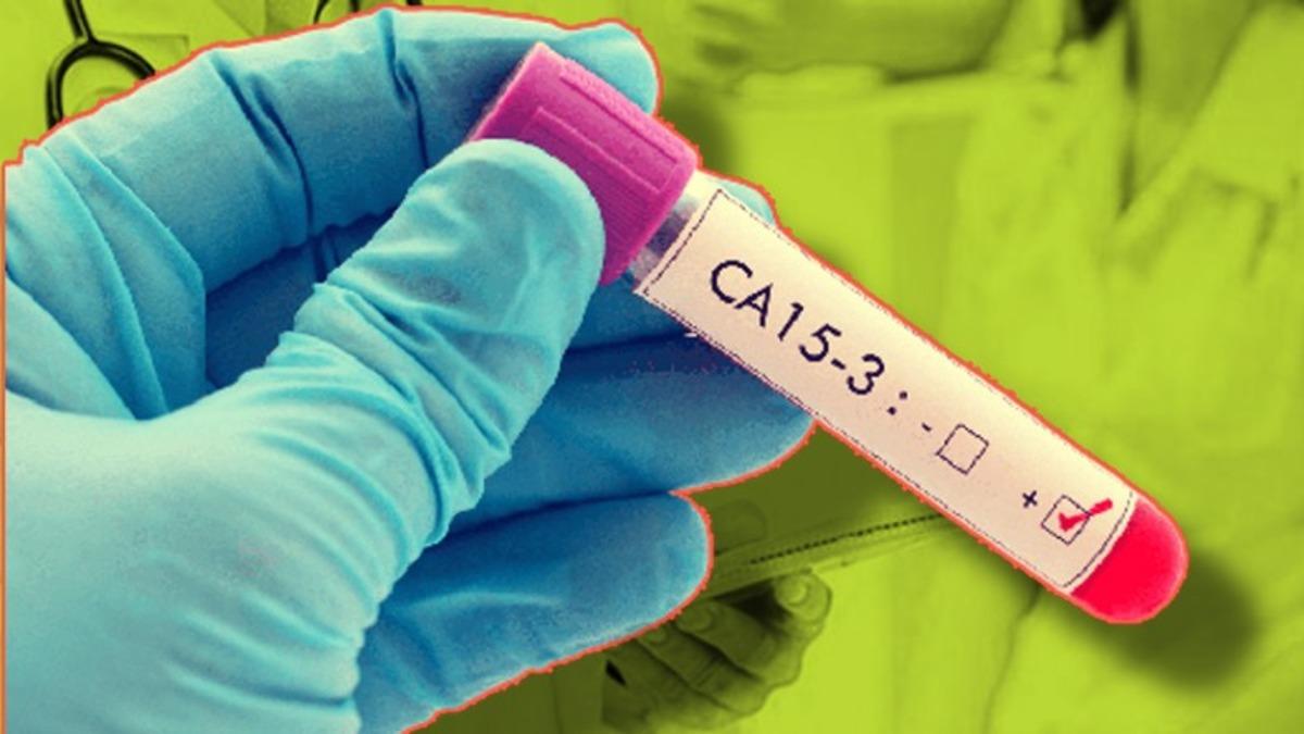 Kan Tahlilinde Karşımıza Çıkan ’CA 15-3’ Nedir, Neden Ciddiye Almalıyız?