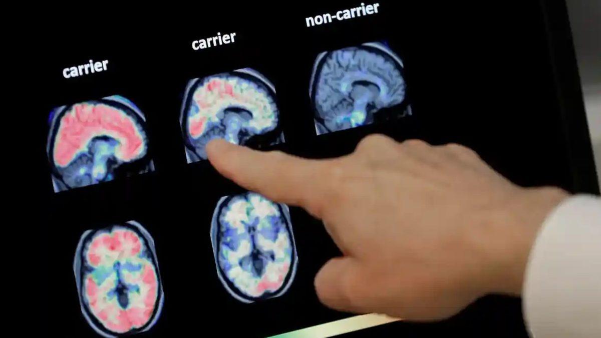 Demansı(Bunama) Sadece Bir Günde Tespit Edebilen Yapay Zeka Geliştirildi