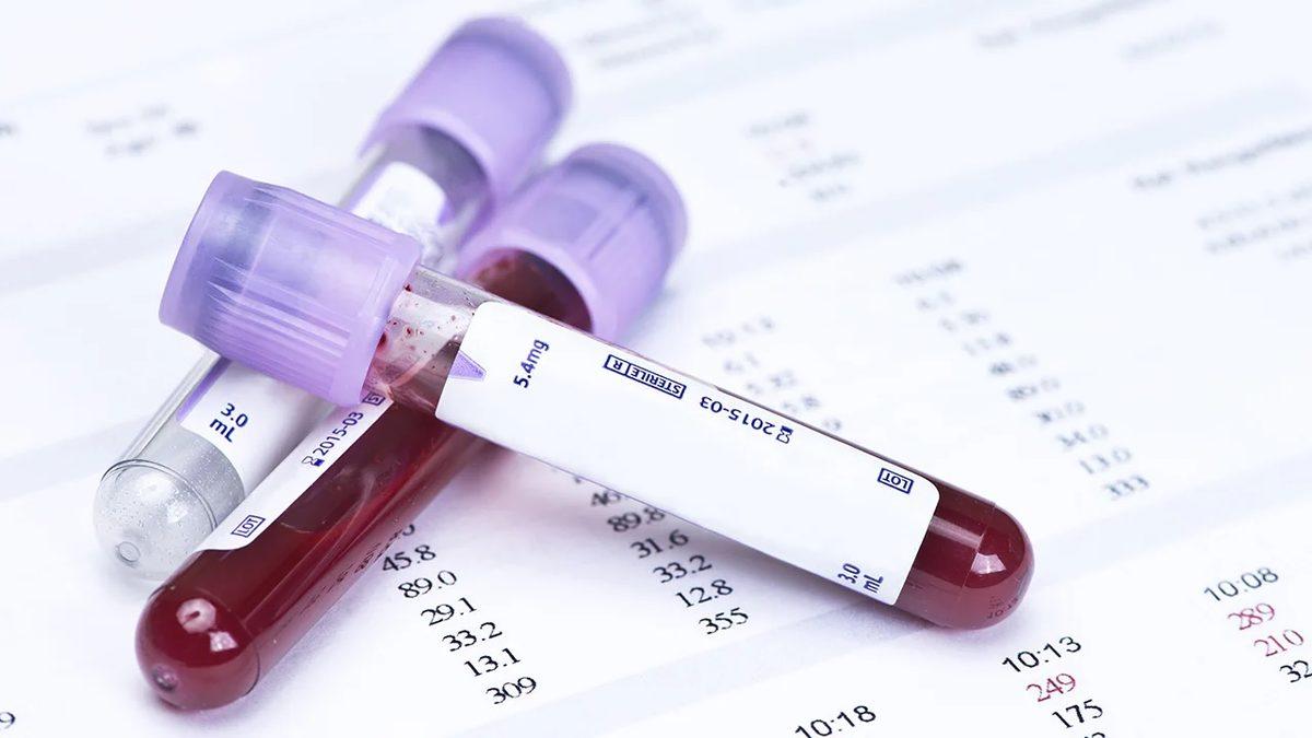 Kan Testlerinde Karşımıza Çıkan CA - 125 Ne Anlatır, Yüksekliği Neden Ciddiye Alınmalı?