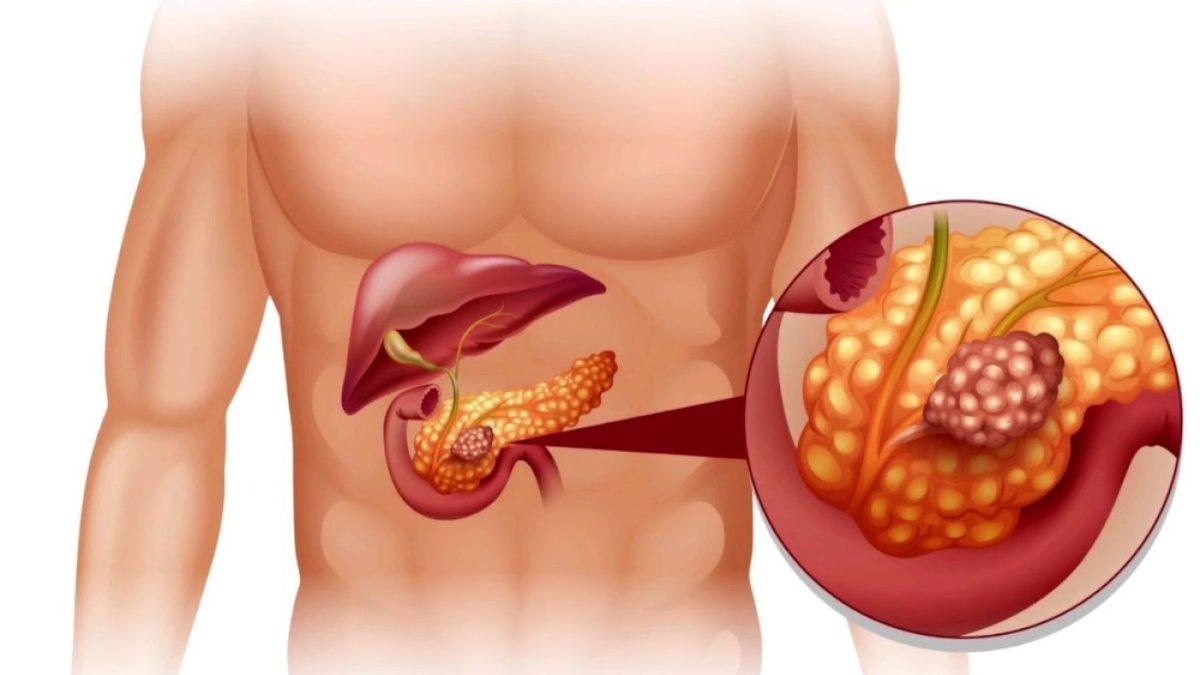 Kan Tahlillerinde Karşılaştığımız ’CA 19-9’ Değeri Bize Ne Anlatır, Yüksekliğini Neden Ciddiye Almalıyız?