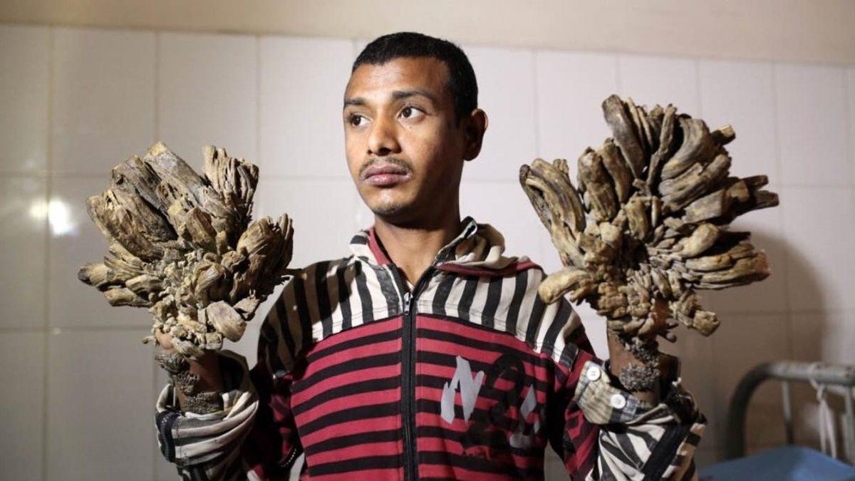 Vücutta Ağaç Köklerine Benzeyen Çıkıntılara Neden Olan Tuhaf Hastalık: Üstelik Buna Neden Olan Virüsü Yakından Tanıyorsunuz!