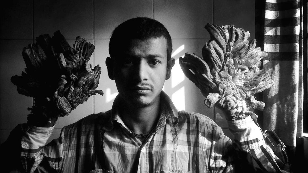 Vücutta Ağaç Köklerine Benzeyen Çıkıntılara Neden Olan Tuhaf Hastalık: Üstelik Buna Neden Olan Virüsü Yakından Tanıyorsunuz!