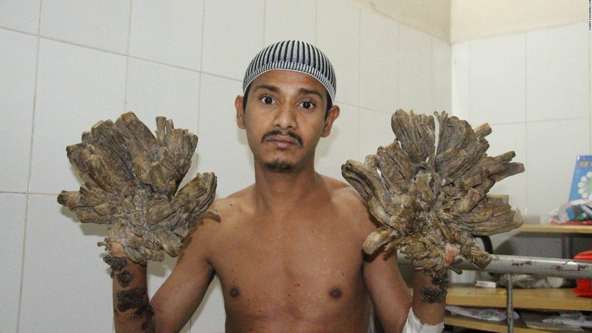 Vücutta Ağaç Köklerine Benzeyen Çıkıntılara Neden Olan Tuhaf Hastalık: Üstelik Buna Neden Olan Virüsü Yakından Tanıyorsunuz!