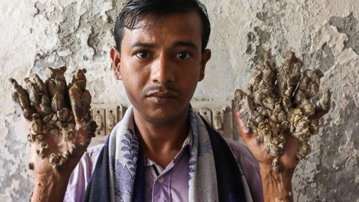 Vücutta Ağaç Köklerine Benzeyen Çıkıntılara Neden Olan Tuhaf Hastalık: Üstelik Buna Neden Olan Virüsü Yakından Tanıyorsunuz!