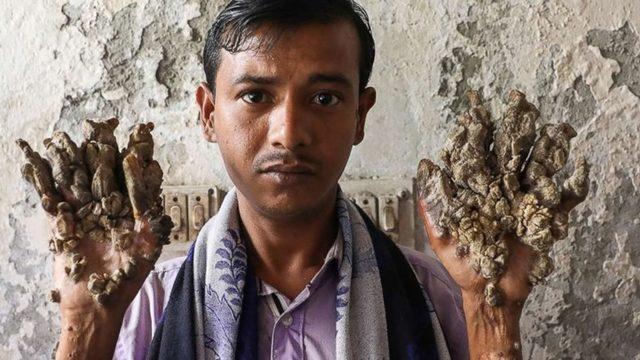 Vücutta Ağaç Köklerine Benzeyen Çıkıntılara Neden Olan Tuhaf Hastalık: Üstelik Buna Neden Olan Virüsü Yakından Tanıyorsunuz!