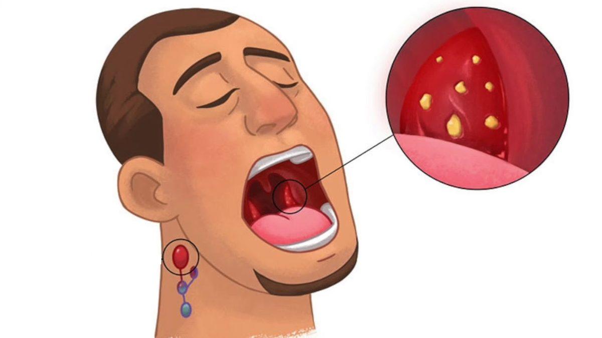 Boğazınızı ‘Düğüm Düğüm’ Hissetmenize Neden Olan Rahatsızlık: Bademcik Taşı Nedir, Nasıl Temizlenir?