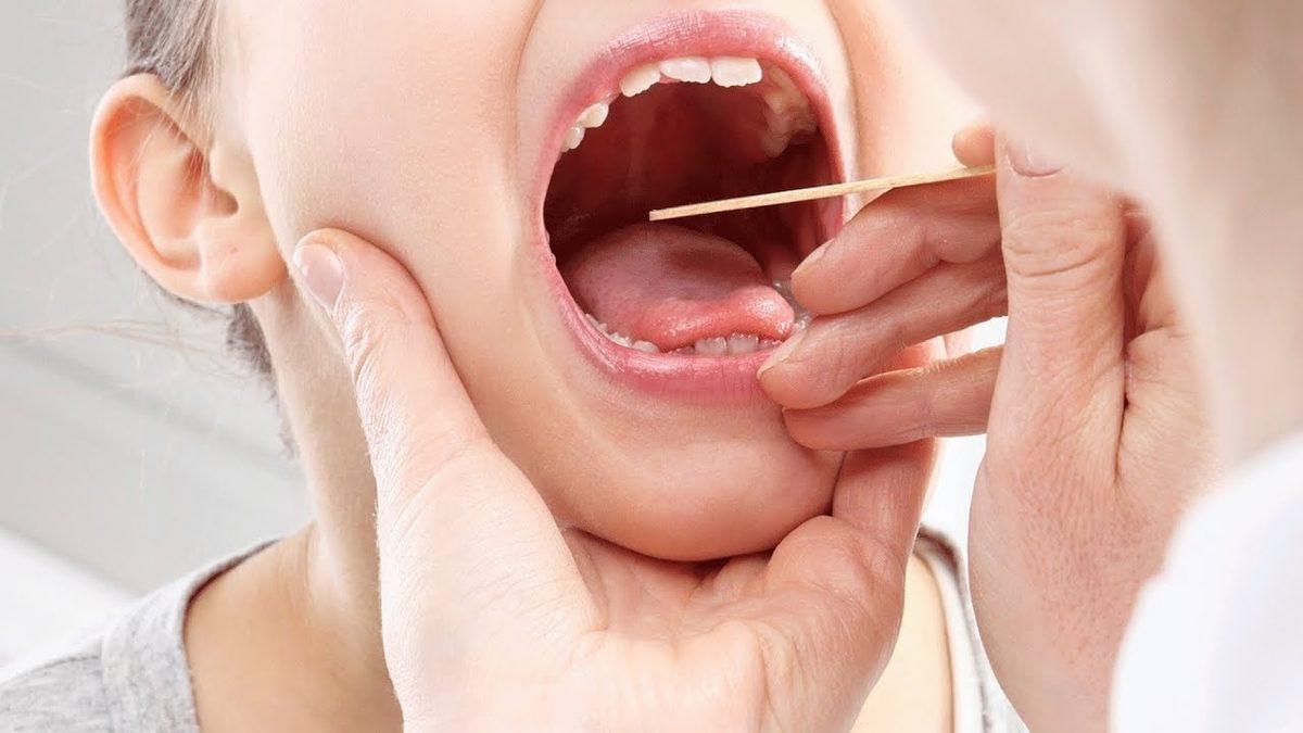 Boğazınızı ‘Düğüm Düğüm’ Hissetmenize Neden Olan Rahatsızlık: Bademcik Taşı Nedir, Nasıl Temizlenir?