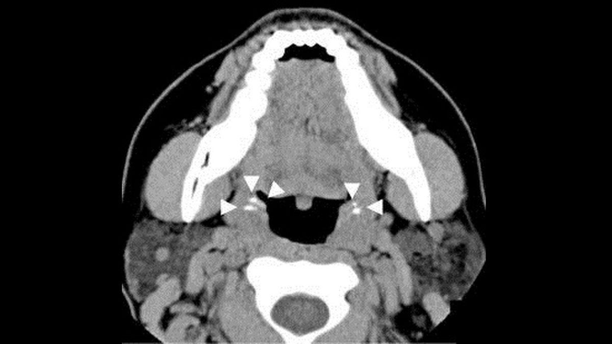 Boğazınızı ‘Düğüm Düğüm’ Hissetmenize Neden Olan Rahatsızlık: Bademcik Taşı Nedir, Nasıl Temizlenir?