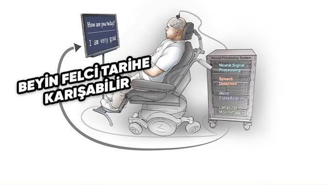 Beyin Felci Geçiren Bir Hasta, Geliştirilen İmplant Sayesinde Sadece Düşünerek “Konuşabiliyor”