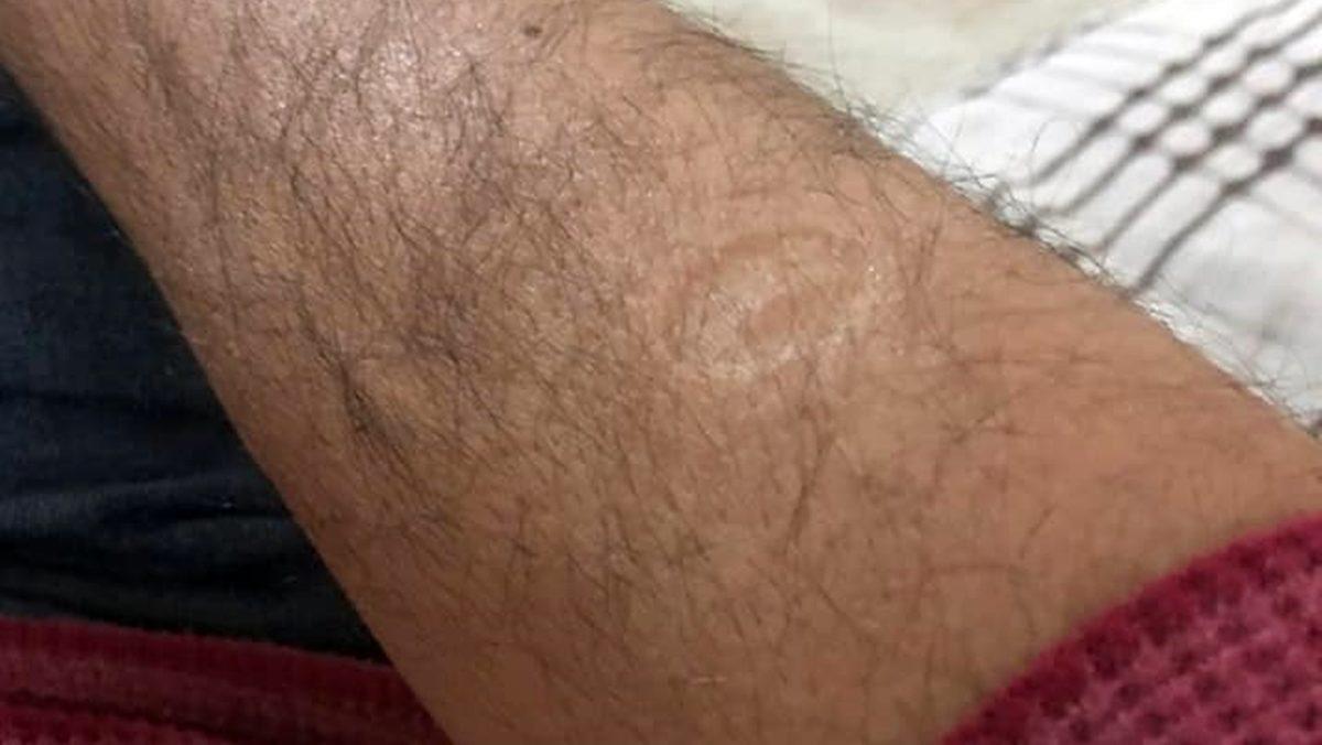 Çiçek ve Verem Aşısı Kolumuzda İz Bırakırken Covid Aşısı Neden İz Bırakmaz?