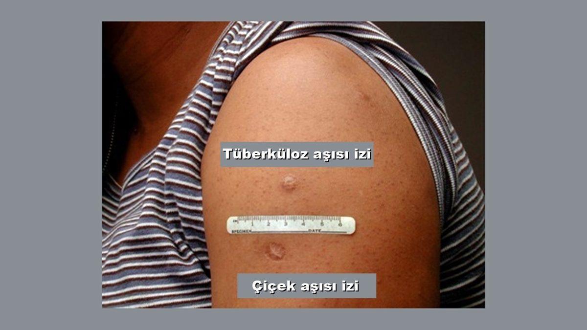 Çiçek ve Verem Aşısı Kolumuzda İz Bırakırken Covid Aşısı Neden İz Bırakmaz?