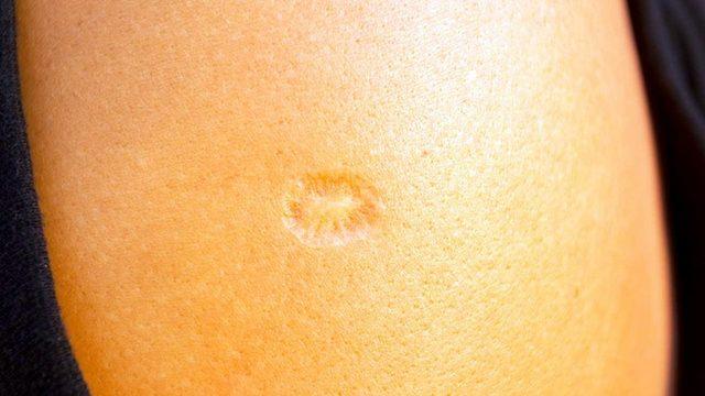 Çiçek ve Verem Aşısı Kolumuzda İz Bırakırken Covid Aşısı Neden İz Bırakmaz?