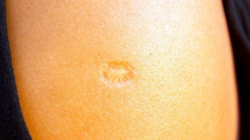 Çiçek ve Verem Aşısı Kolumuzda İz Bırakırken Covid Aşısı Neden İz Bırakmaz?