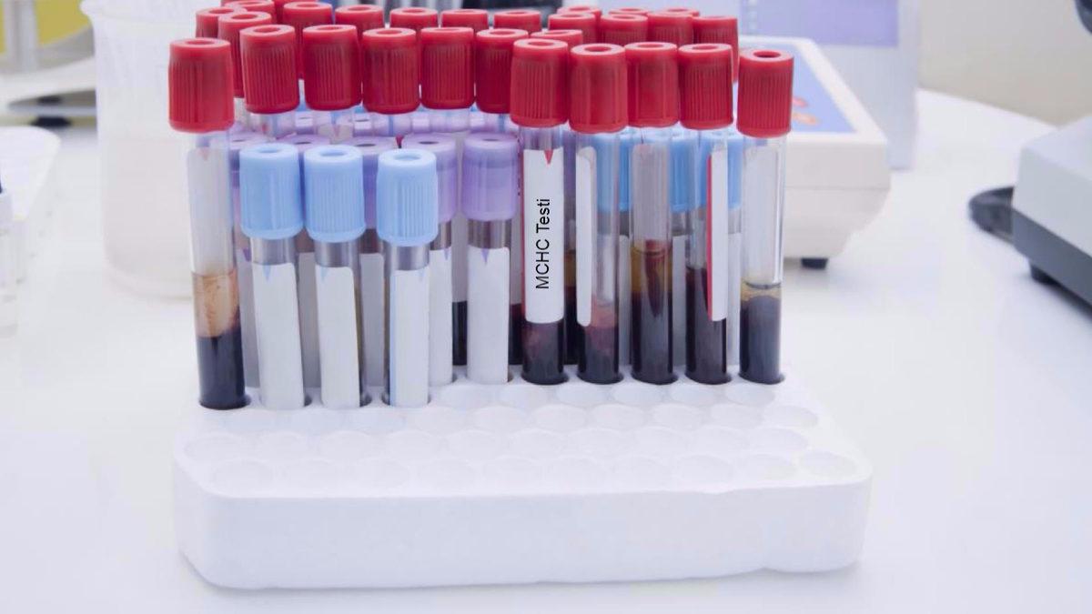 Vücudumuzdaki Oksijen Akışının Sağlıklı Bir Şekilde Sürdürülmesini Sağlayan MCHC Nedir, Yüksekliği ve Düşüklüğü Ne Anlama Gelir?