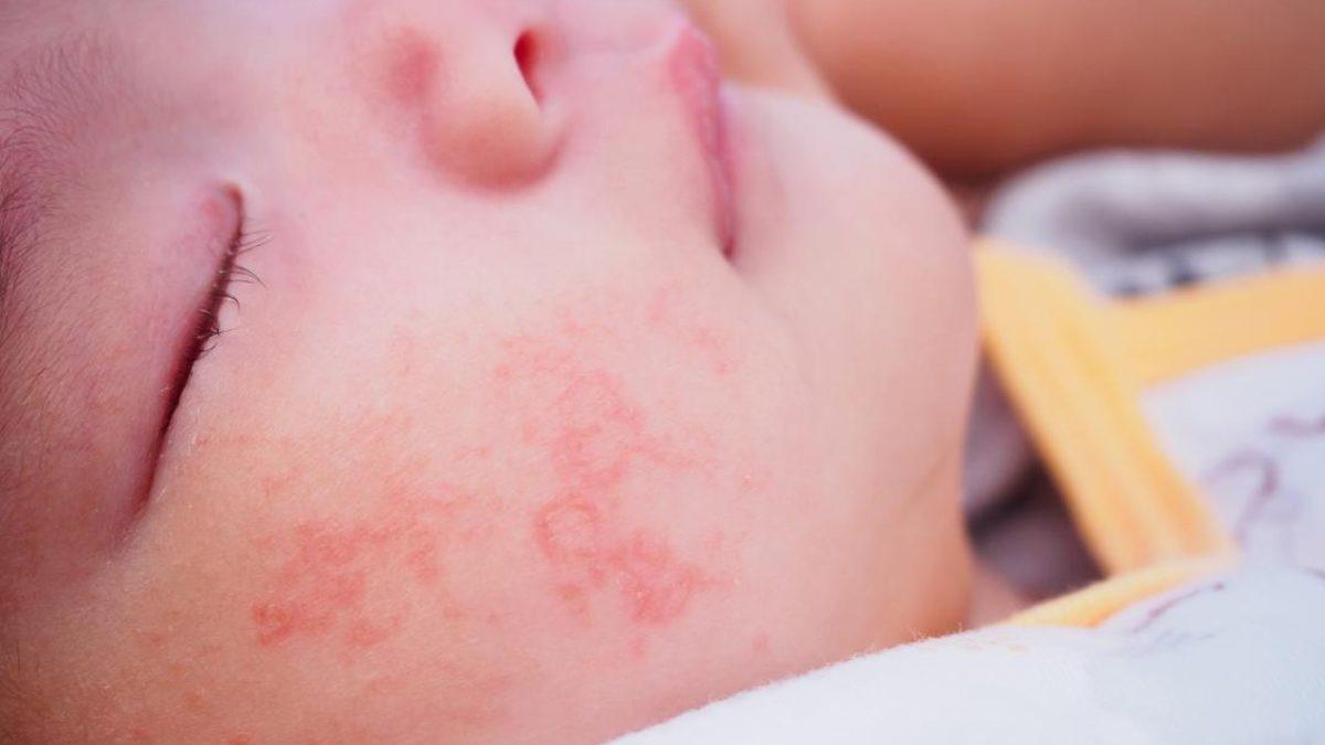 Ölüme Bile Götüren ’Gıda Alerjisi’ Neden Her Geçen Gün Daha Fazla İnsanda Görülüyor?