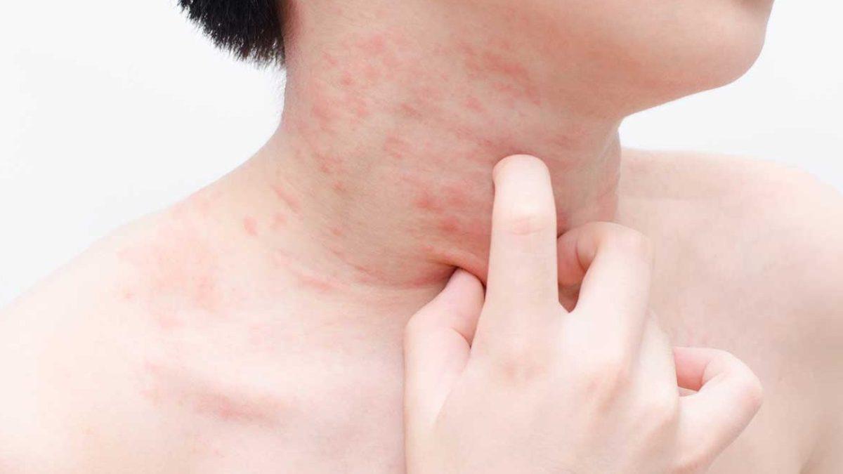 Ölüme Bile Götüren ’Gıda Alerjisi’ Neden Her Geçen Gün Daha Fazla İnsanda Görülüyor?