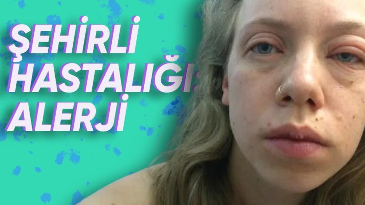 Ölüme Bile Götüren ’Gıda Alerjisi’ Neden Her Geçen Gün Daha Fazla İnsanda Görülüyor?