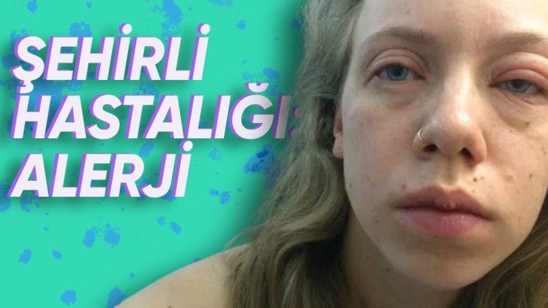 Ölüme Bile Götüren ’Gıda Alerjisi’ Neden Her Geçen Gün Daha Fazla İnsanda Görülüyor?