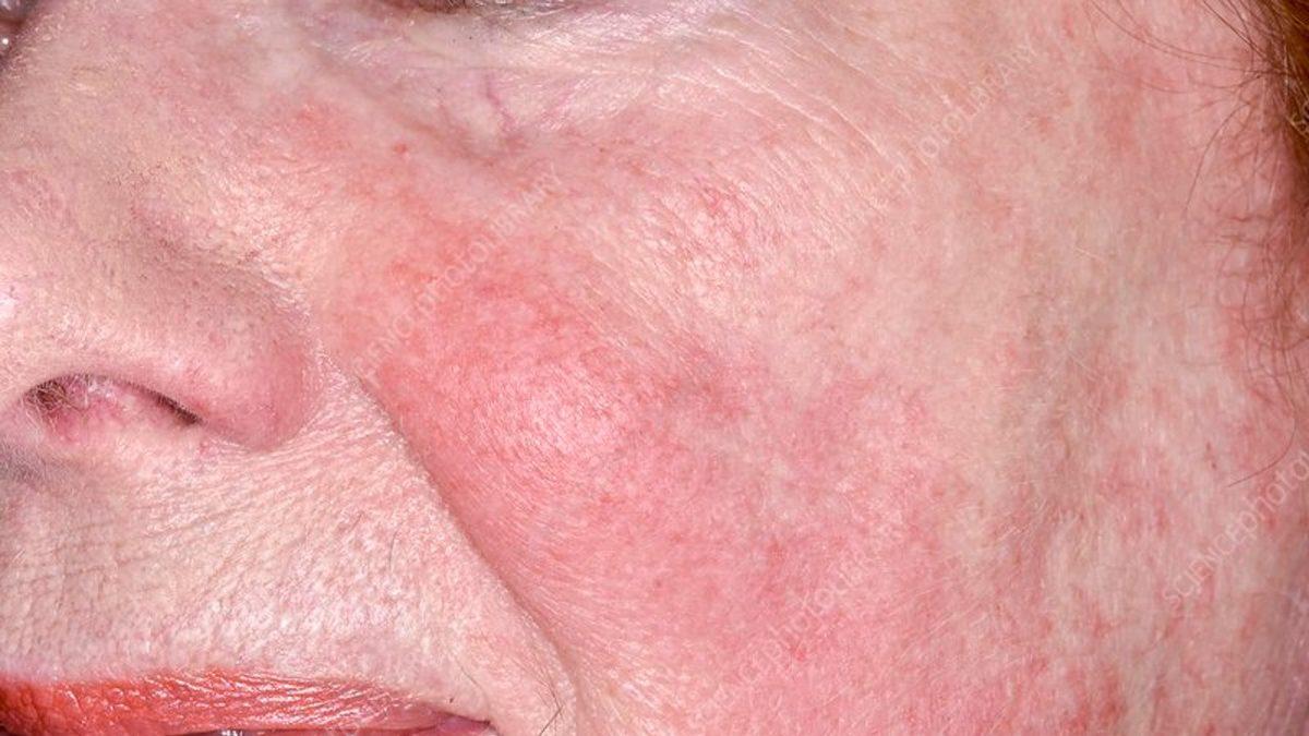 Halk Arasında ‘Yılancık Hastalığı’ Olarak Bilinen Rahatsızlık Erizipel Nedir, Belirtileri Nelerdir?