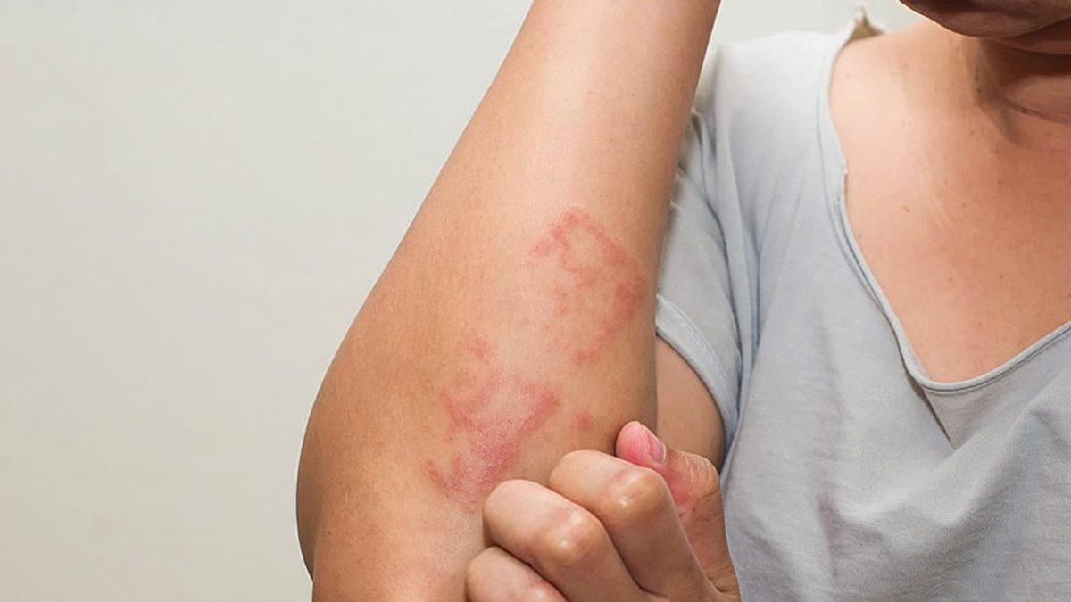 Halk Arasında ‘Yılancık Hastalığı’ Olarak Bilinen Rahatsızlık Erizipel Nedir, Belirtileri Nelerdir?