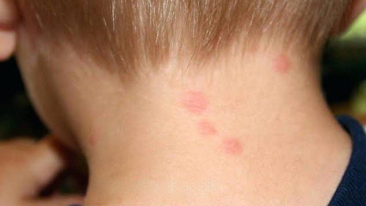 Halk Arasında ‘Yılancık Hastalığı’ Olarak Bilinen Rahatsızlık Erizipel Nedir, Belirtileri Nelerdir?