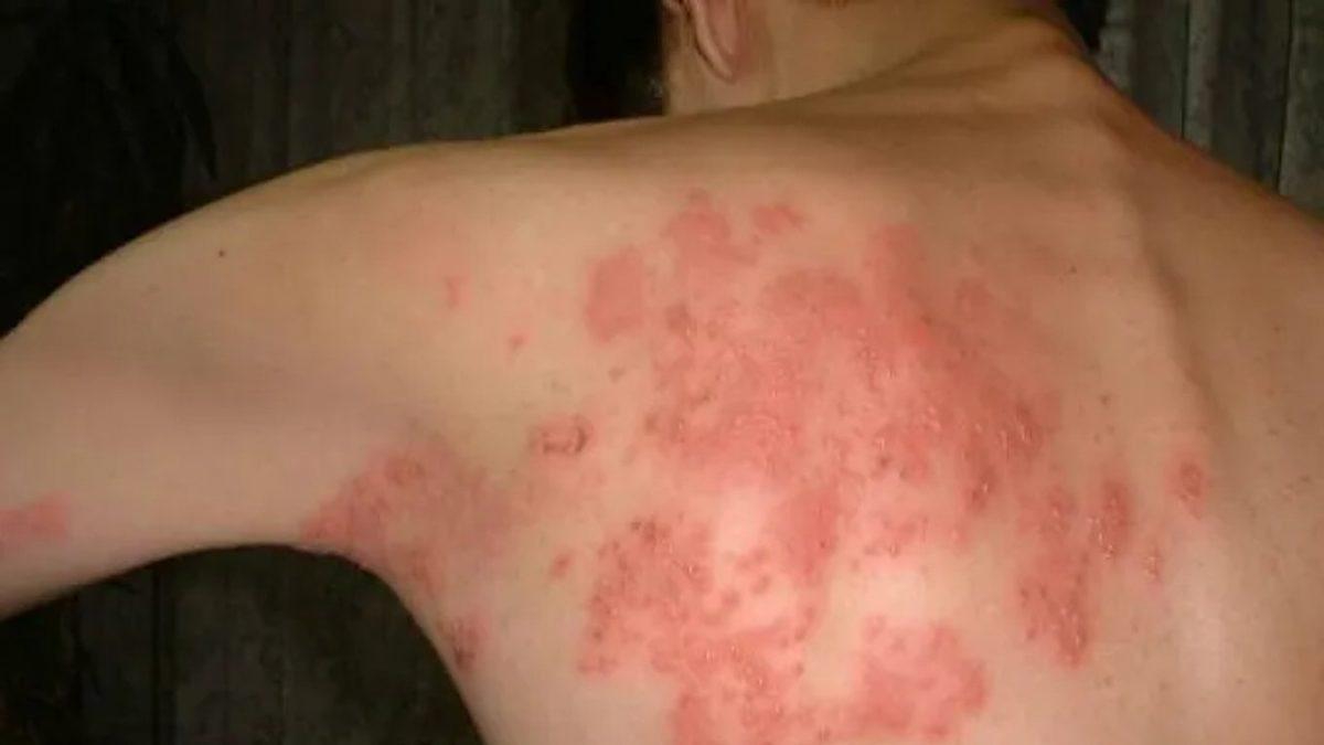 Halk Arasında ‘Yılancık Hastalığı’ Olarak Bilinen Rahatsızlık Erizipel Nedir, Belirtileri Nelerdir?