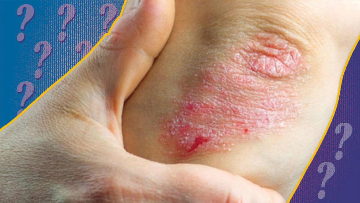 Halk Arasında ‘Yılancık Hastalığı’ Olarak Bilinen Rahatsızlık Erizipel Nedir, Belirtileri Nelerdir?