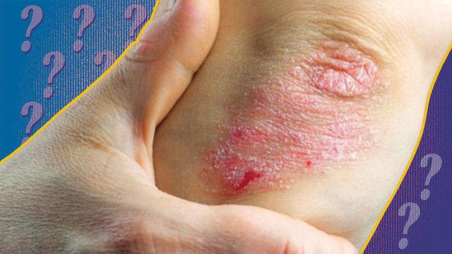 Halk Arasında ‘Yılancık Hastalığı’ Olarak Bilinen Rahatsızlık Erizipel Nedir, Belirtileri Nelerdir?