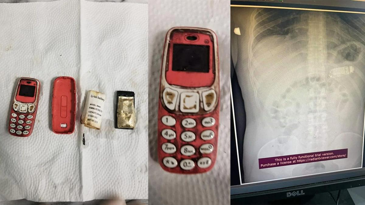 Kıramayınca Sinirlenip Yemiş: Bir Adamın Midesinden Nokia 3310 Çıkarıldı