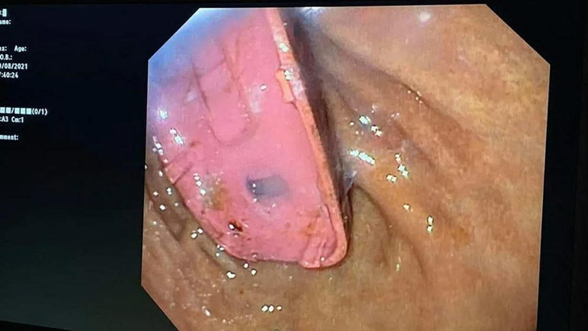 Kıramayınca Sinirlenip Yemiş: Bir Adamın Midesinden Nokia 3310 Çıkarıldı