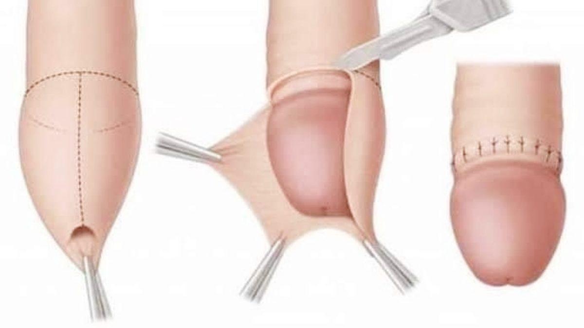 Hani Azıcık Ucundandı? Sünnetin Cinsel Hayata ve Erken Boşalmaya Etkisine Bilim Penceresinden Bakıyoruz