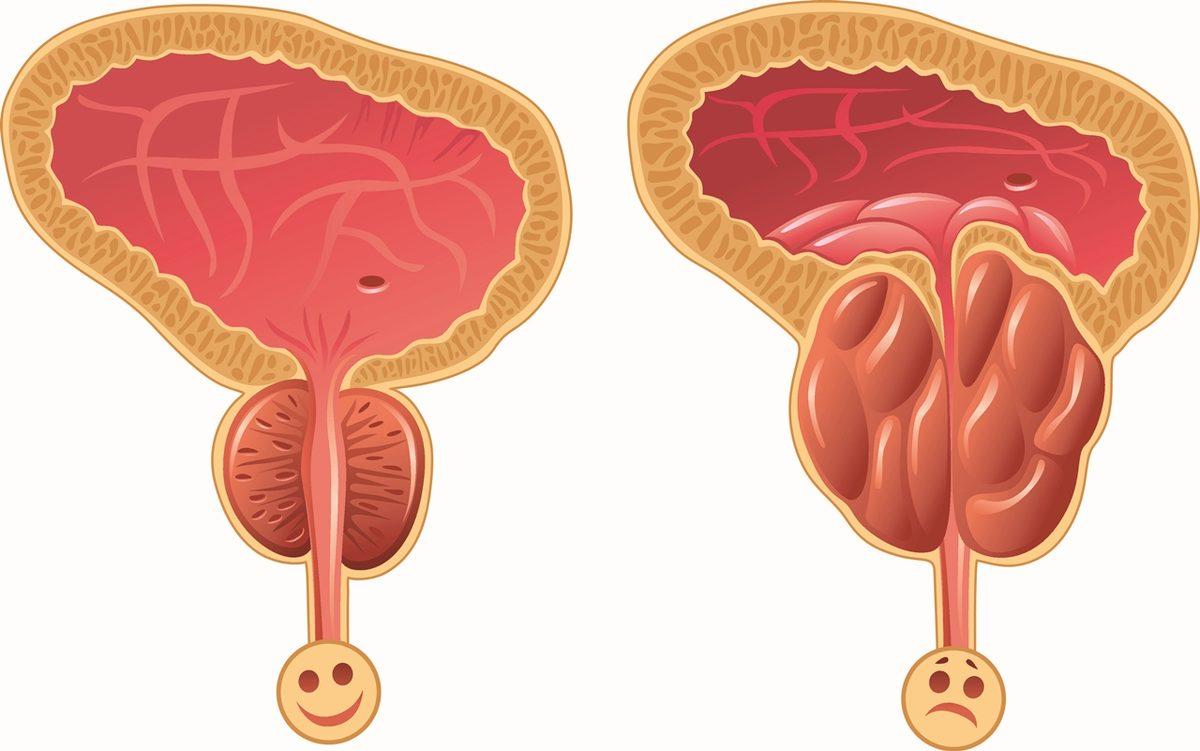 Erkekler Toplanın! Ayakta İşemenin Prostat Kanserine Bir Etkisinin Olup Olmadığını Açıklıyoruz