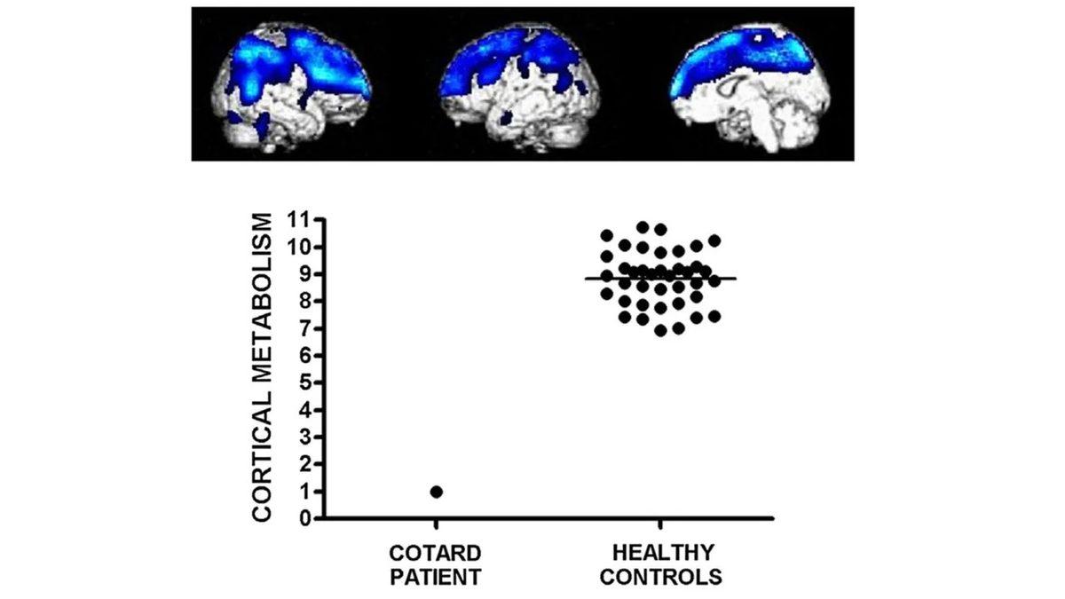 Öğrenince Şaşıracağınız Sıra Dışı 7 Psikolojik Sendrom
