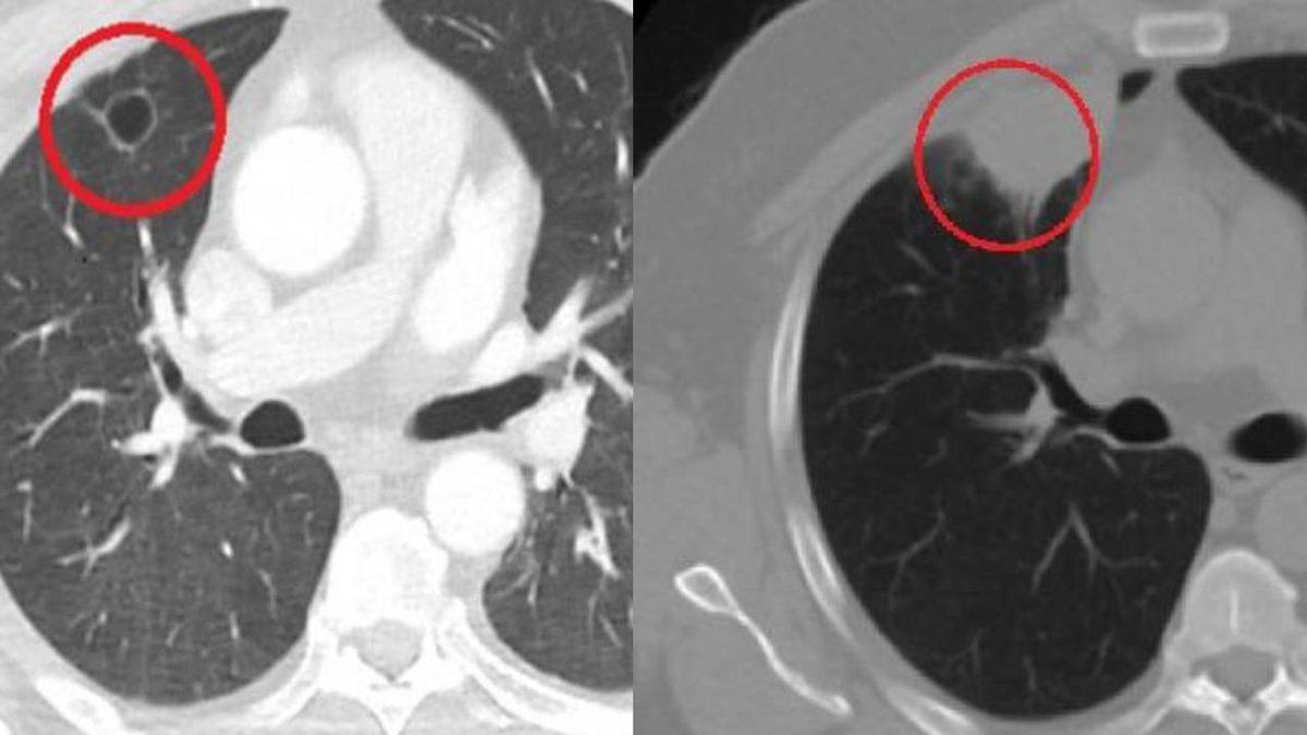 Dünyada Bir İlk: Başta Akciğer Kanseri Tanısı Konan Bir Vatandaşta Koronavirüsün Kanseri Taklit Ettiği Tespit Edildi