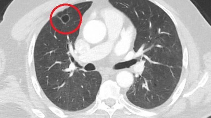 Dünyada Bir İlk: Başta Akciğer Kanseri Tanısı Konan Bir Vatandaşta Koronavirüsün Kanseri Taklit Ettiği Tespit Edildi