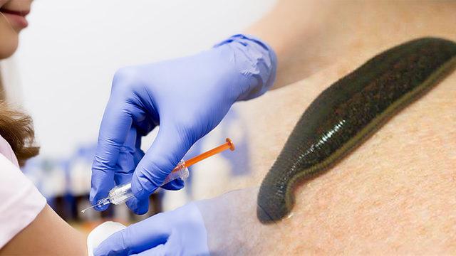 Şeytanın Aklına Gelmez: Aşılı Gözükmek İsteyen Bir Aşı Karşıtı, Aşıyı Emsin Diye Koluna Sülük Yapıştırdı