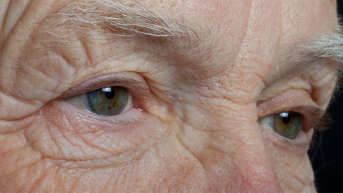 Göz Bozukluğu Olanlarda ’Bunama’ Riskinin Daha Yüksek Olduğu Ortaya Çıktı