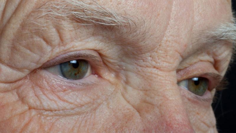 Göz Bozukluğu Olanlarda ’Bunama’ Riskinin Daha Yüksek Olduğu Ortaya Çıktı