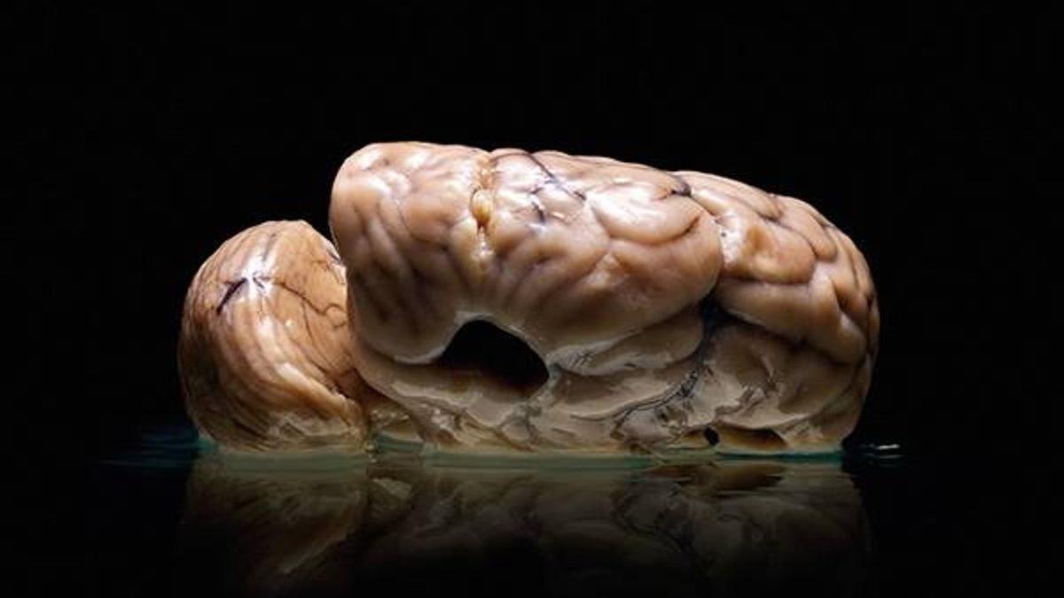 Akıl Hastalarının Birbirinden Çok Farklı Görünen Beyinleri: Kıvrımsız Olanı Bile Var!