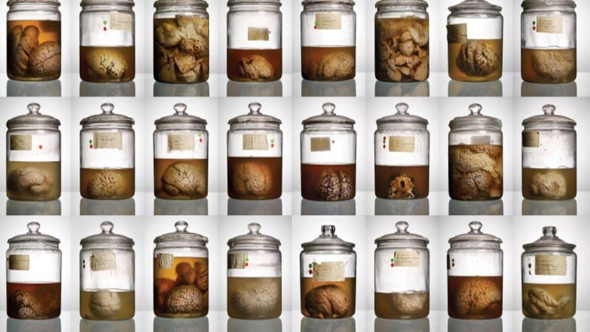 Akıl Hastalarının Birbirinden Çok Farklı Görünen Beyinleri: Kıvrımsız Olanı Bile Var!