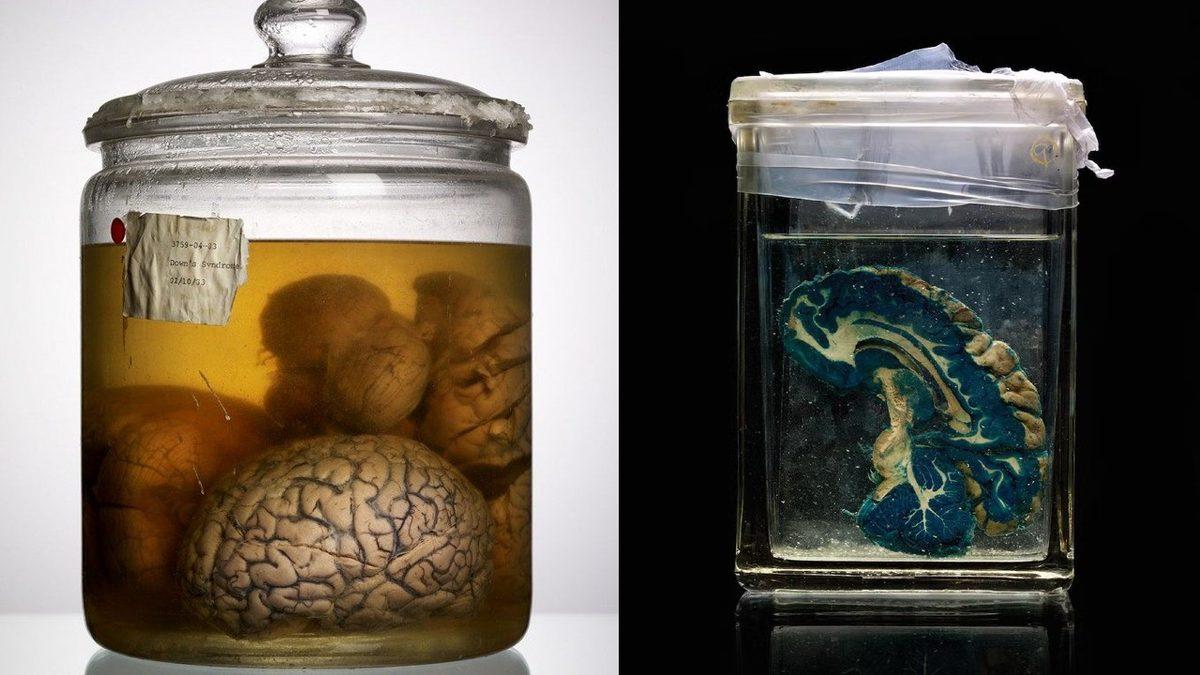 Akıl Hastalarının Birbirinden Çok Farklı Görünen Beyinleri: Kıvrımsız Olanı Bile Var!